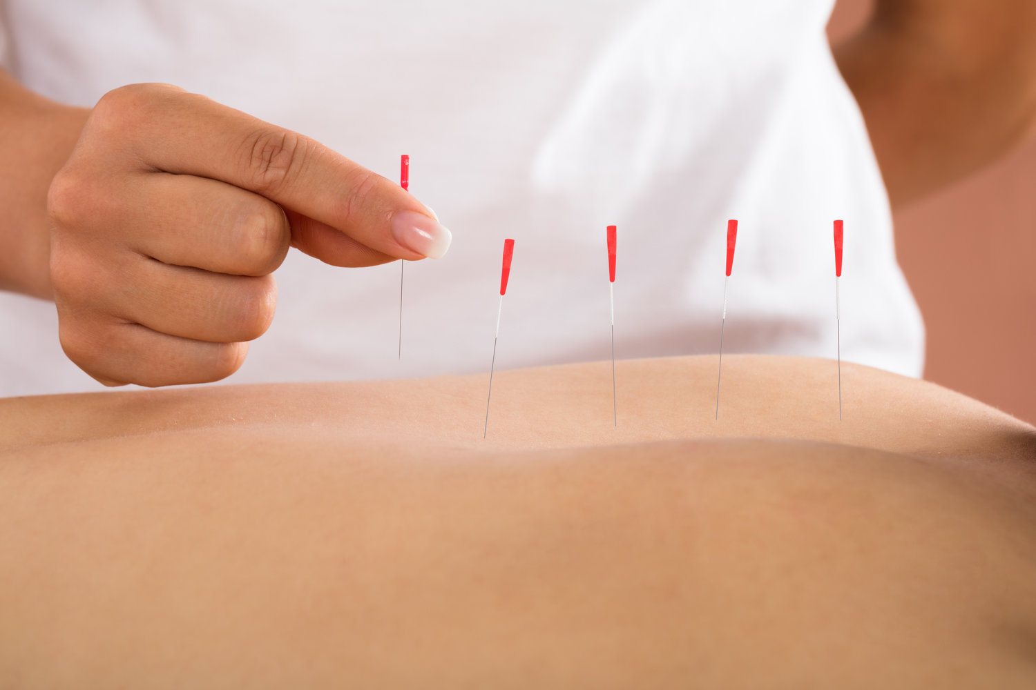 Close-up Of Person Receiving Acupuncture Treatment In A Beauty Spa